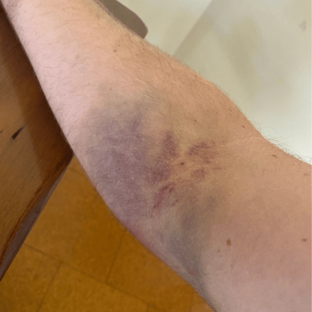 Eastern Brown Snake Bite - I am Lucky to Be Alive